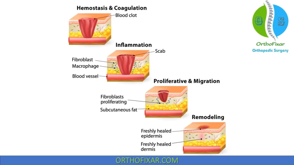 Tissue Healing Stages