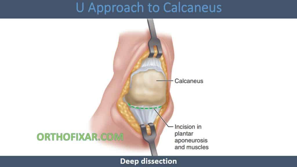 U Approach to Calcaneus