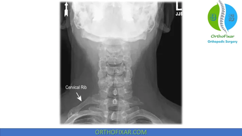 cervical rib x-ray
