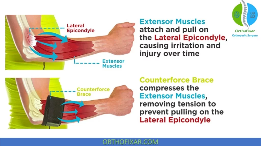 counterforce bracing- tennis elbow