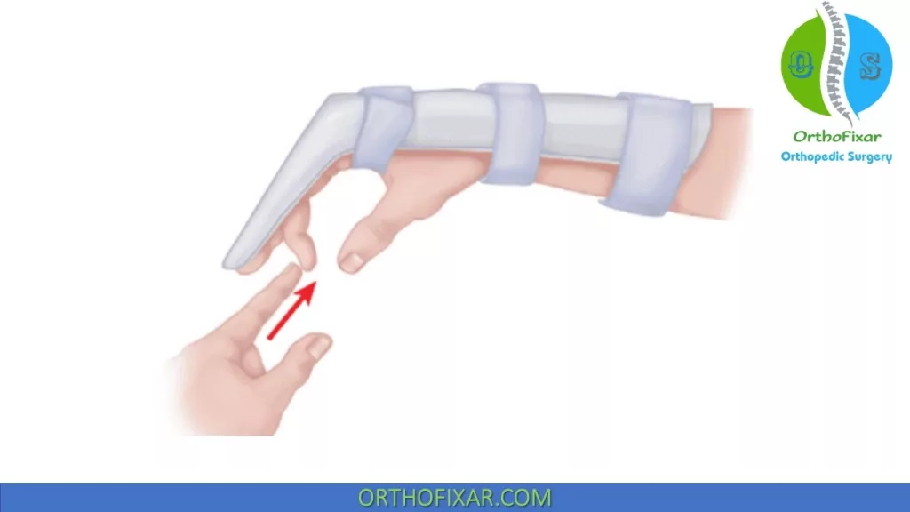 flexor tendon rehabilitation