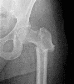  Subtrochanteric femur fracture’s most common deformity after antegrade nailing 